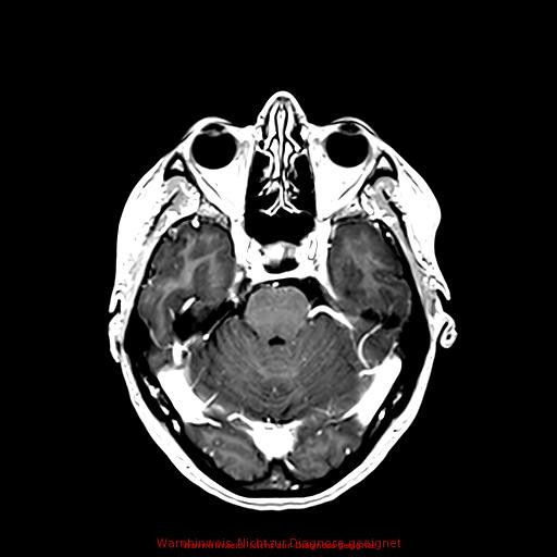 Normal adult brain MRI (non-enhanced and contrast-enhanced) (Radiopaedia 75262-86379 Axial T1 C+ 79).jpg