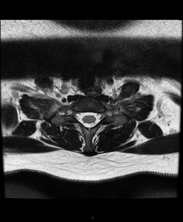 Normal cervical spine MRI (Radiopaedia 80146-93454 Axial T2 90).jpg