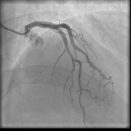 Normal coronary angiogram (DSA) (Radiopaedia 63081-71571 E 49).jpg