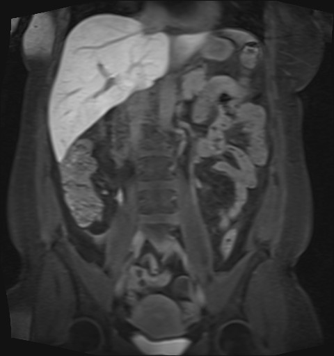 File:Normal hepatobiliary phase liver MRI (Radiopaedia 58968-66230 B 26).jpg