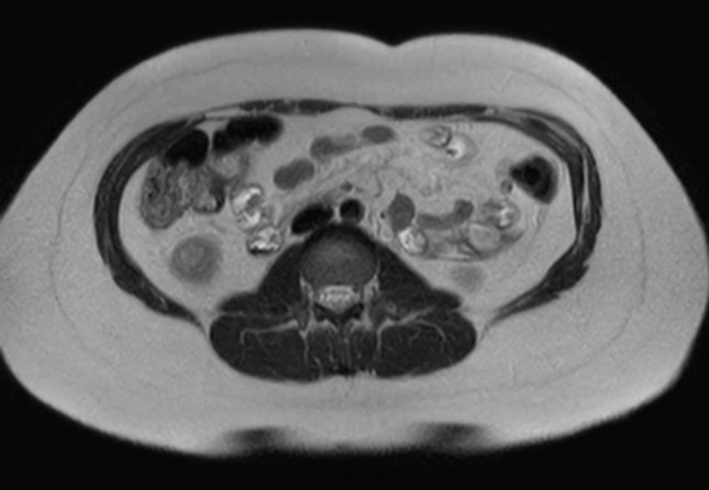 File:Normal liver MRI with Gadolinium (Radiopaedia 58913-66163 Axial T2 6).jpg