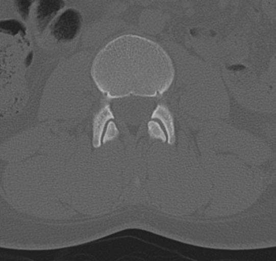 File:Normal lumbar spine CT (Radiopaedia 46533-50986 Axial bone window 32).png