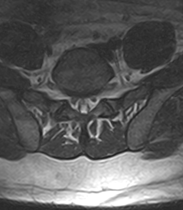 Normal lumbar spine MRI - low-field MRI scanner (Radiopaedia 40976-43699 Axial T2 86).jpg