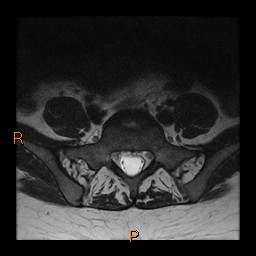 File:Normal spine MRI (Radiopaedia 77323-89408 Axial T2 25).jpg