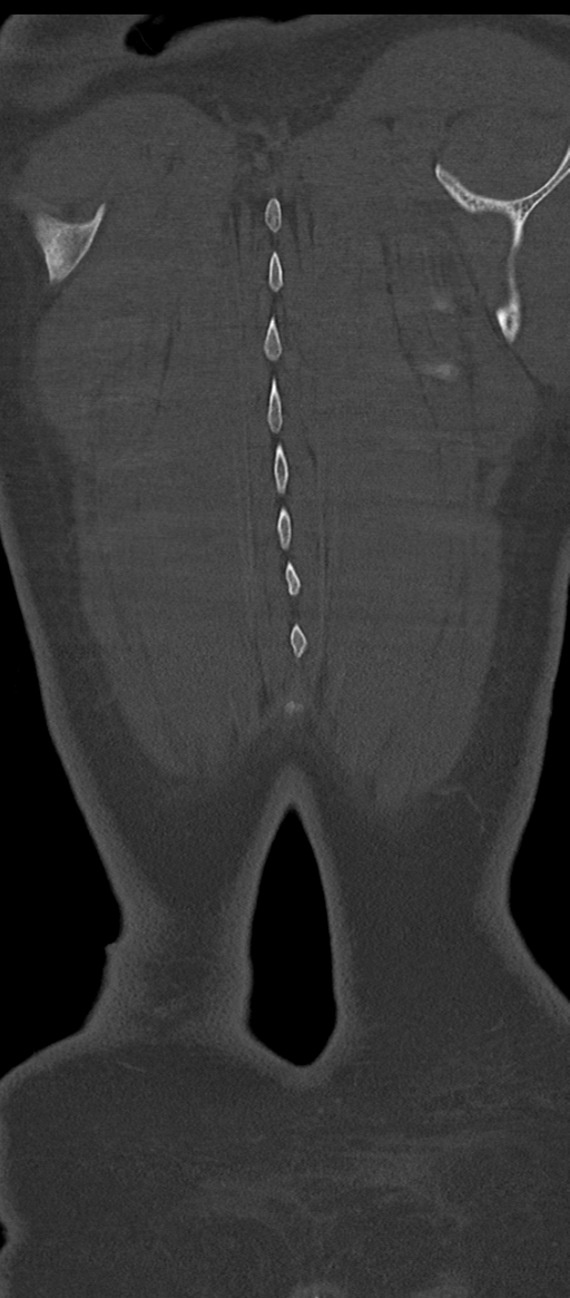 Normal thoracolumbar spine (Radiopaedia 43822-47309 Coronal bone window 87).png