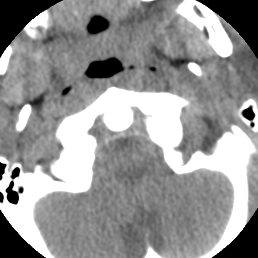 Normal trauma cervical spine (Radiopaedia 41017-43760 Axial non-contrast 11).png