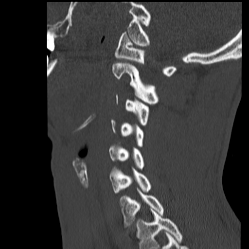 File:Normal trauma cervical spine (Radiopaedia 41017-43760 Sagittal bone window 32).png