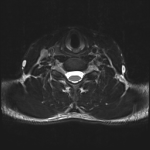 Normal trauma cervical spine (Radiopaedia 41017-43762 D 38).png