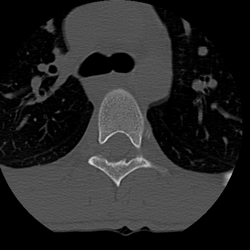 Normal trauma spine imaging (age 16) (Radiopaedia 45335-49358 Axial bone window 112).jpg