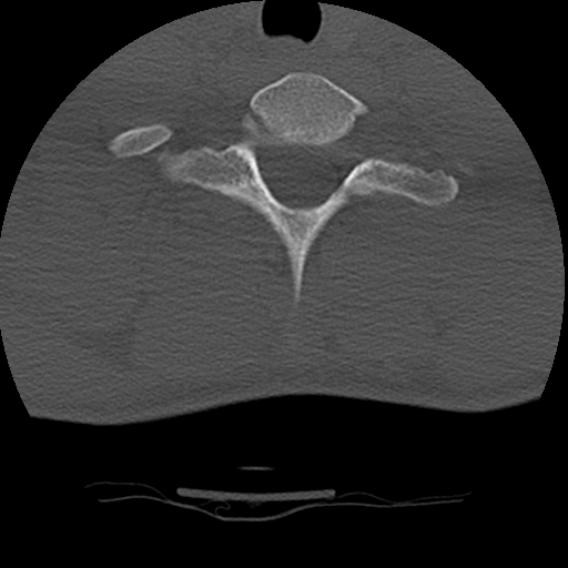 Normal trauma spine imaging (age 16) (Radiopaedia 45335-49358 Axial bone window 67).jpg