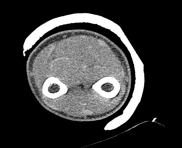 Normal wrist CT (Radiopaedia 41425-44297 Axial non-contrast 60).png