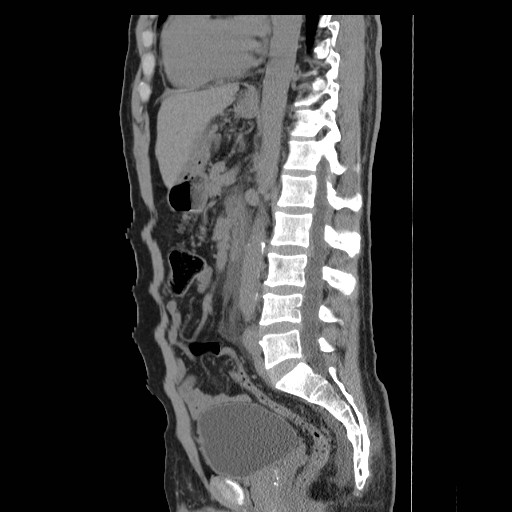 File:Obstructed kidney with perinephric urinoma (Radiopaedia 26889-27066 B 36).jpg