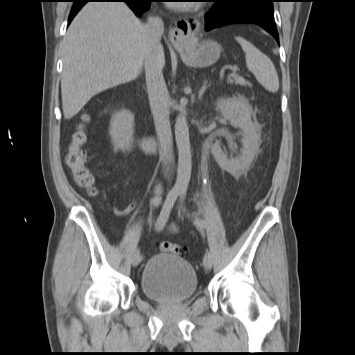 Obstructing renal calculus (Radiopaedia 29517-30016 Coronal non-contrast 29).jpg