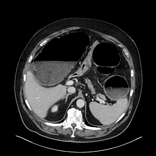 Obstructing sigmoid adenocarcinoma (Radiopaedia 58465-65619 A 45).jpg