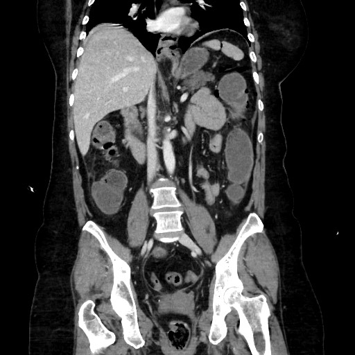 Obstructive distal colonic adenocarcinoma causing cecal perforation (Radiopaedia 86830-102989 C 106).jpg