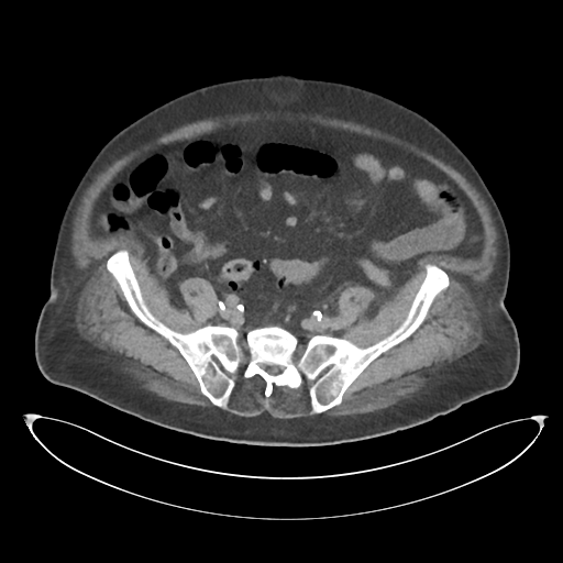 File:Obstructive pyelonephritis (Radiopaedia 46411-50844 Axial non-contrast 58).png