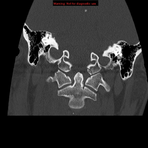 File:Occipital condyle fracture (Radiopaedia 18366-18208 Coronal bone window 9).jpg