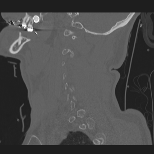 File:Occipital condyle fracture (Radiopaedia 33467-34517 Sagittal bone window 17).png