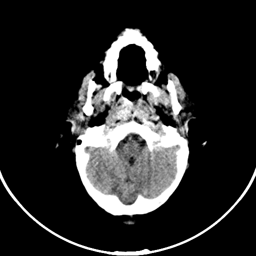 Occipital encephalocele (Radiopaedia 87339-103636 Axial non-contrast 19).jpg