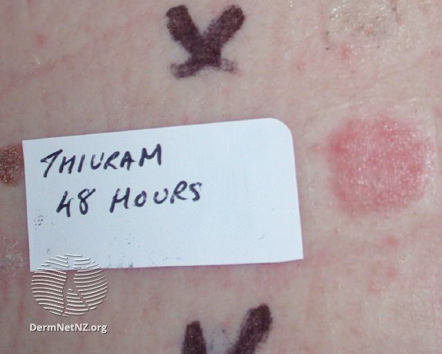 File:Positive patch test to thiuram (DermNet NZ dermatitis-thiuram).jpg