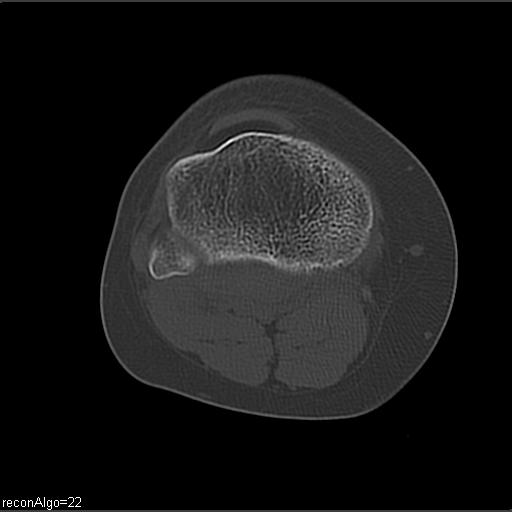 File:ACL avulsion fracture (Radiopaedia 33833-34994 Axial bone window 21).jpg