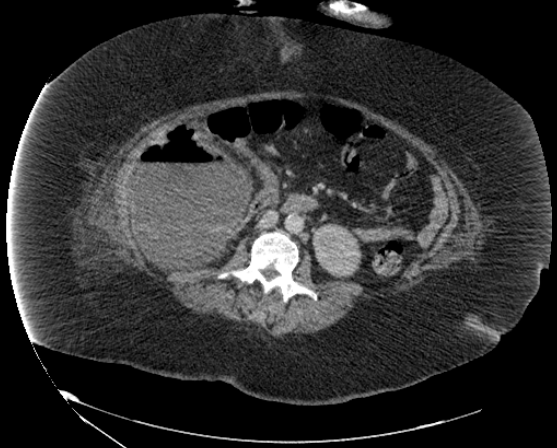 File:Abdominal abscess - pre and post percutaneous drainage (Radiopaedia 60209-67816 Axial 1).png