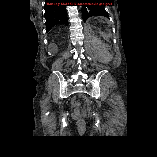 Abdominal aortic aneurysm- extremely large, ruptured (Radiopaedia 19882-19921 Coronal C+ arterial phase 80).jpg