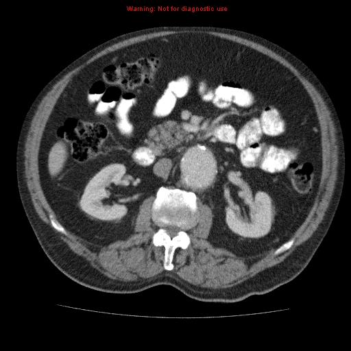 Abdominal aortic aneurysm (Radiopaedia 10122-10660 Axial C+ portal venous phase 32).jpg