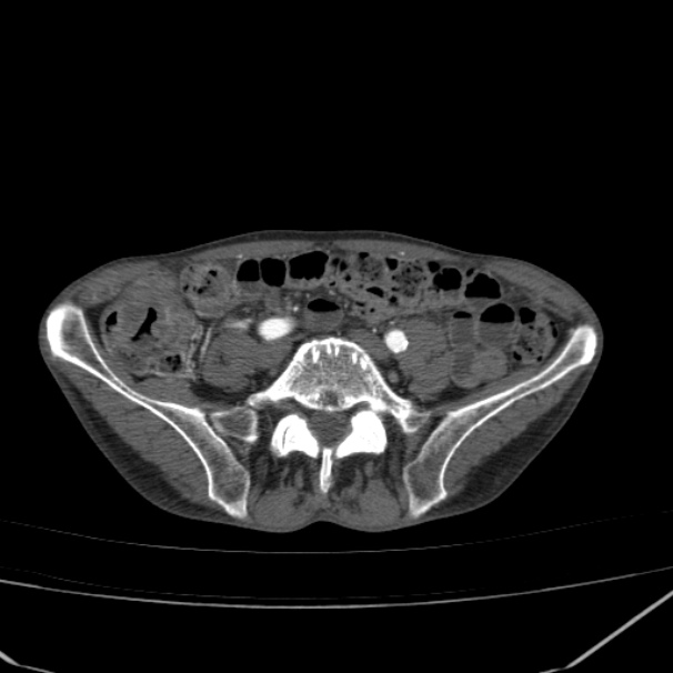 Abdominal aortic aneurysm (Radiopaedia 23703-23856 Axial C+ arterial phase 66).jpg
