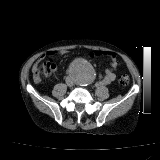 Abdominal aortic aneurysm (Radiopaedia 29248-29660 Axial non-contrast 38).jpg