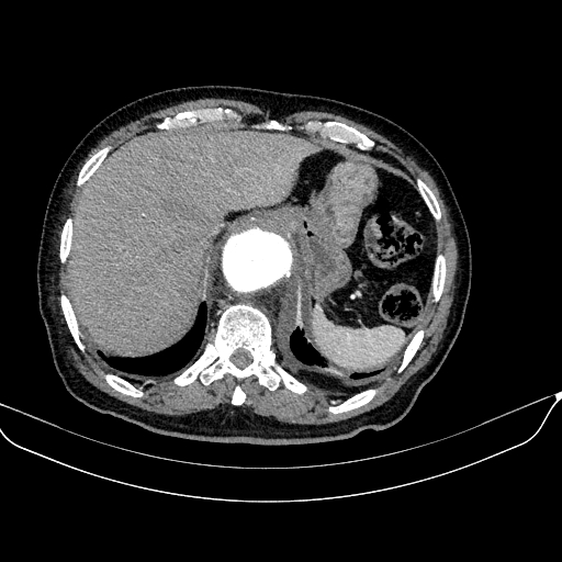Abdominal aortic aneurysm (Radiopaedia 67117-76452 Axial C+ arterial phase 24).jpg