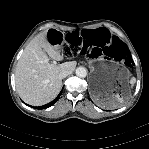 Abdominal aortic aneurysm (Radiopaedia 83581-98689 Axial C+ portal venous phase 23).jpg