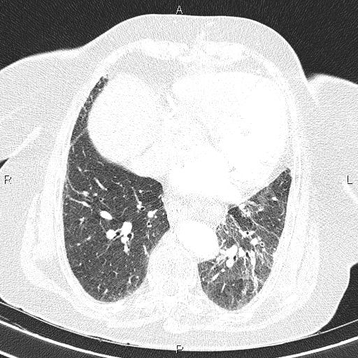 File:Abdominal aortic aneurysm (Radiopaedia 85063-100606 Axial lung window 45).jpg