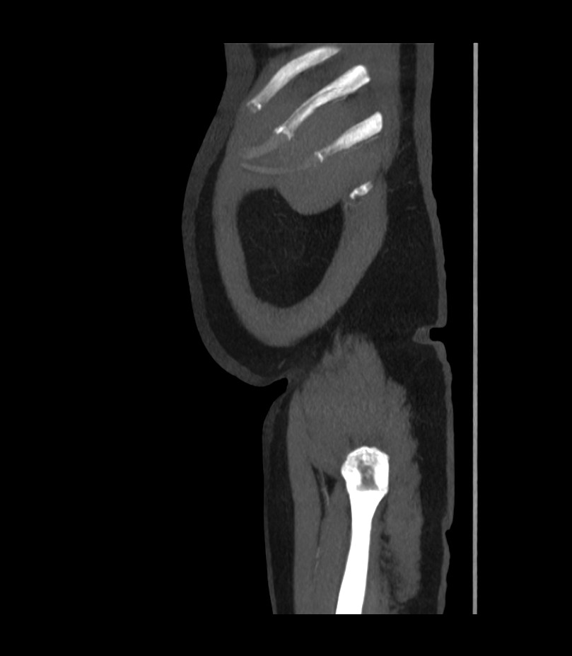 Abdominal aortic aneurysm with thrombus fissuration (Radiopaedia 46218-50618 Sagittal C+ arterial phase 3).jpg
