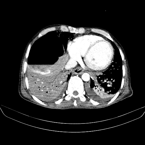 File:Abdominal collection due to previous cecal perforation (Radiopaedia 80831-94320 Axial C+ portal venous phase 12).jpg