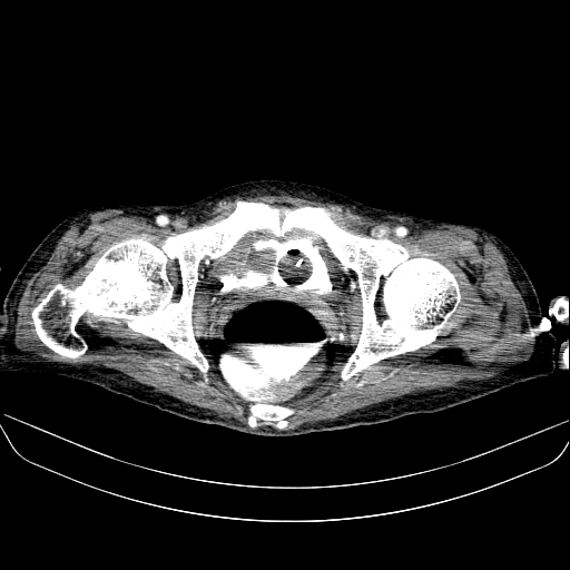 File:Abdominal collection due to previous cecal perforation (Radiopaedia 80831-94320 Axial C+ portal venous phase 197).jpg