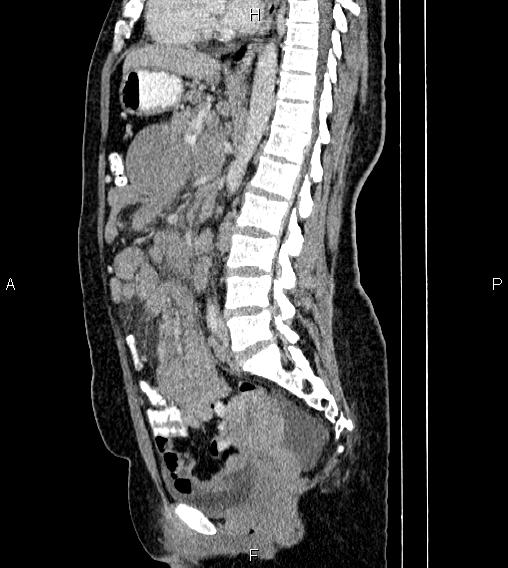 Abdominal lymphoma with sandwich sign (Radiopaedia 84378-99704 Sagittal C+ portal venous phase 45).jpg