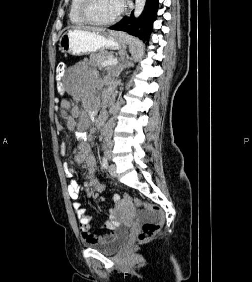 Abdominal lymphoma with sandwich sign (Radiopaedia 84378-99704 Sagittal C+ portal venous phase 53).jpg