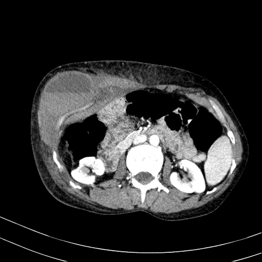 Abdominal wall hematoma with active bleeding (Radiopaedia 83915-99117 Axial renal cortical phase 29).jpg