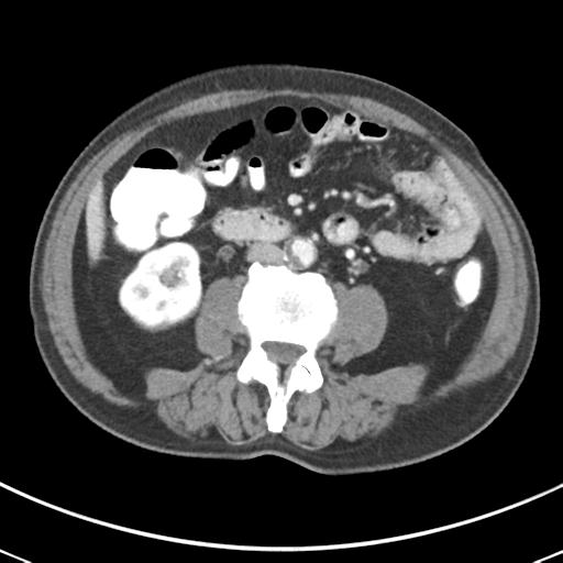 Abdominal wall metastasis from colorectal carcinoma (Radiopaedia 31016-31717 Axial C+ portal venous phase 40).jpg