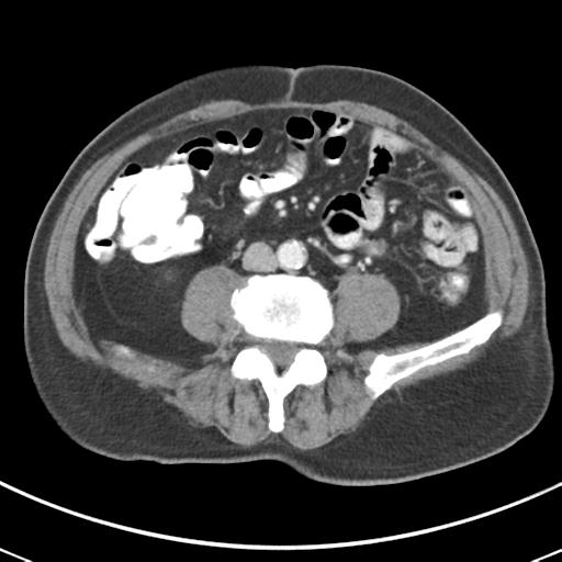 File:Abdominal wall metastasis from colorectal carcinoma (Radiopaedia 31016-31717 Axial C+ portal venous phase 45).jpg