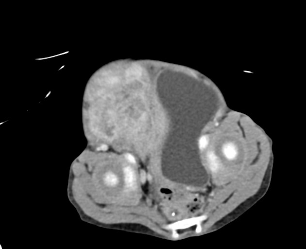 Abdominopelvic rhabdomyosarcoma (Radiopaedia 78356-90984 Axial C+ portal venous phase 142).jpg