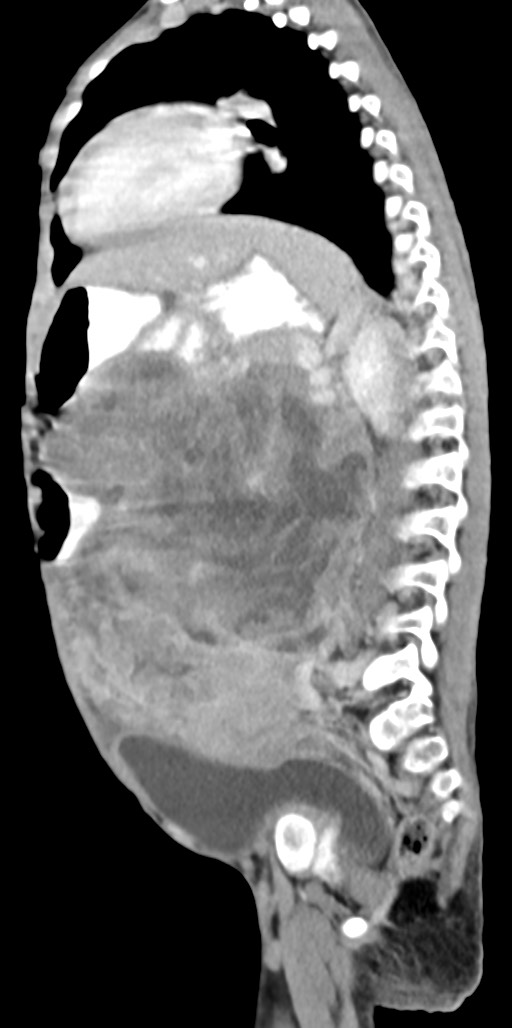 Abdominopelvic rhabdomyosarcoma (Radiopaedia 78356-90984 Sagittal C+ portal venous phase 37).jpg
