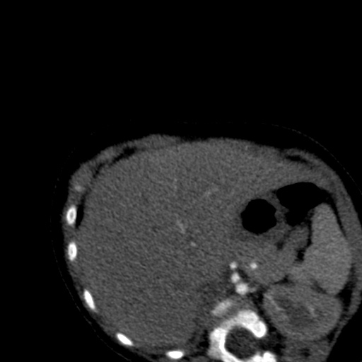 Aberrant left pulmonary artery (pulmonary sling) (Radiopaedia 42323-45435 Axial C+ CTPA 50).jpg