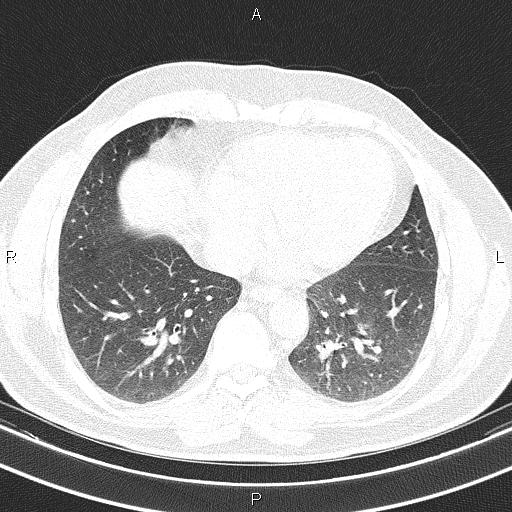 Aberrant right subclavian artery (Radiopaedia 87093-103354 Axial lung window 77).jpg