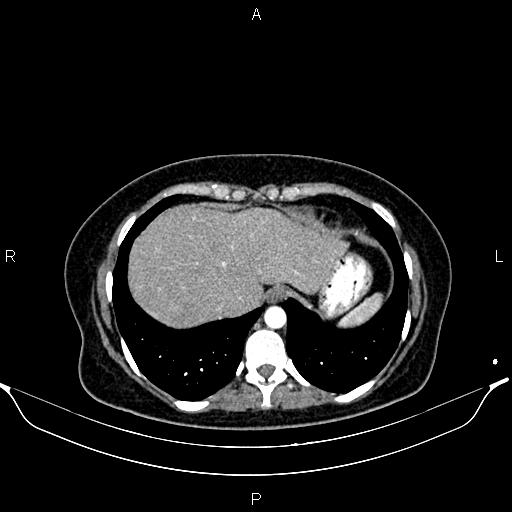 Aberrant right subclavian artery (Radiopaedia 87334-103629 Axial C+ arterial phase 54).jpg