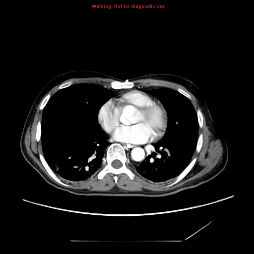 File:Aberrant right subclavian artery (Radiopaedia 9379-10071 Axial C+ arterial phase 40).jpg