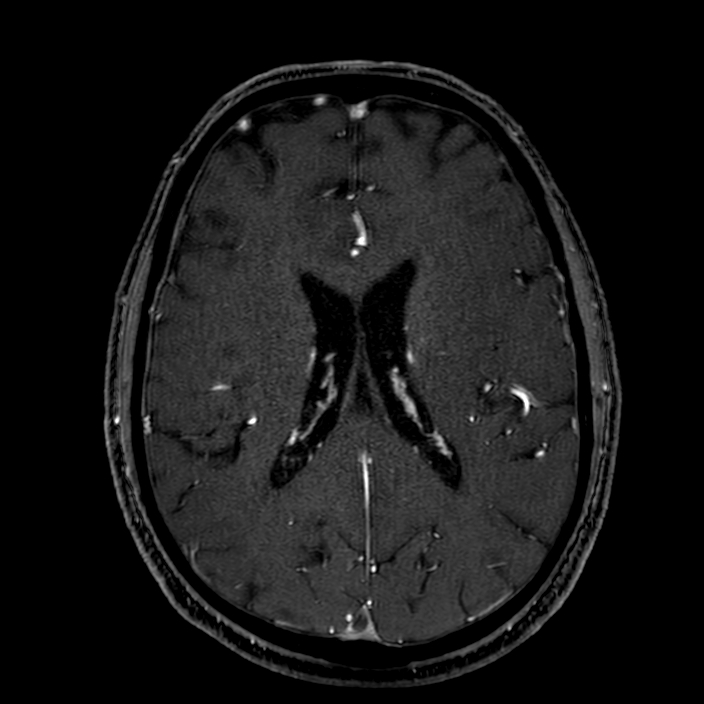 Accessory middle cerebral artery (Radiopaedia 73114-83828 Axial MRA 129).jpg