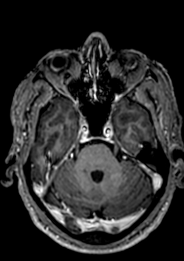Accessory middle cerebral artery (Radiopaedia 73114-83828 Axial T1 C+ 111).jpg