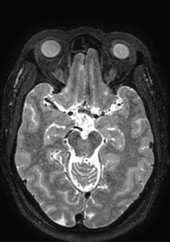 Accessory middle cerebral artery (Radiopaedia 73114-83828 Axial T2 114).jpg